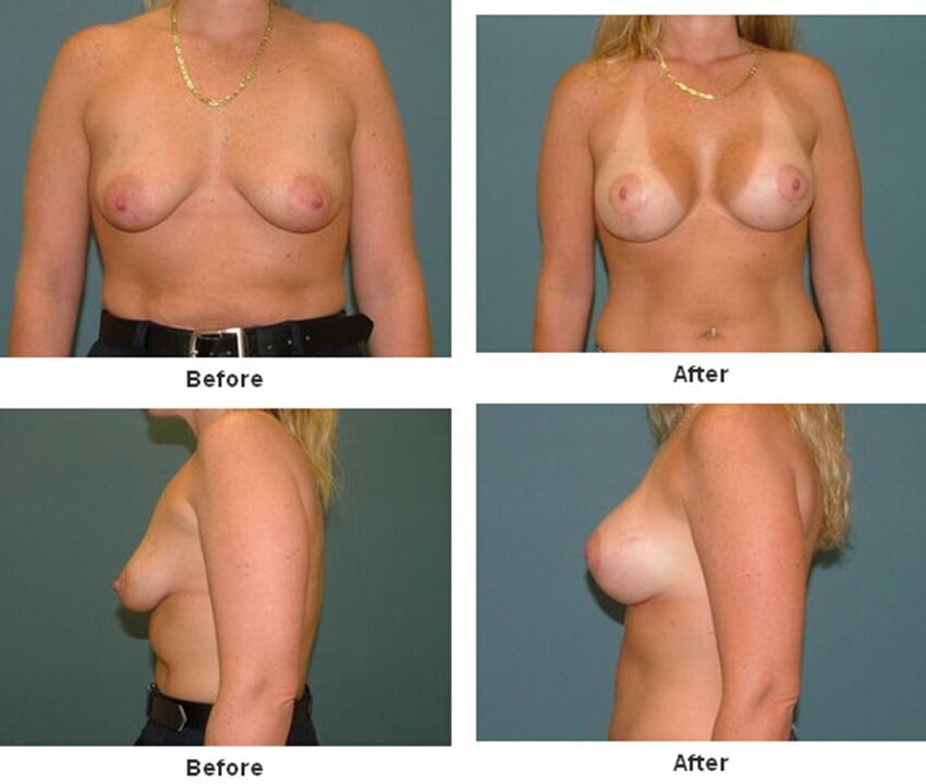 Breast Lift in West Palm Beach 