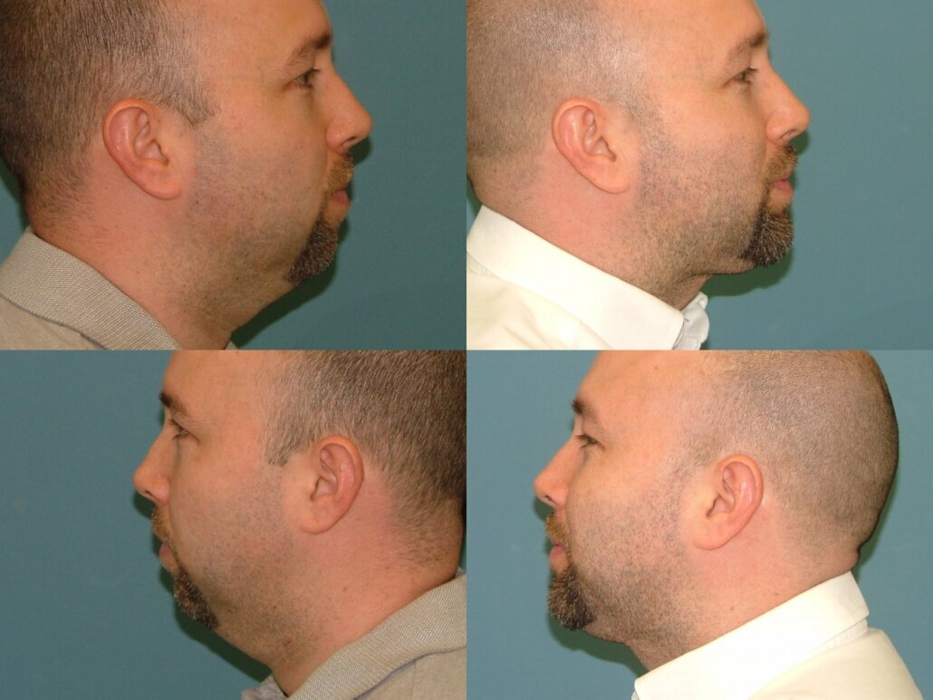 Chin Implants in West Palm Beach 