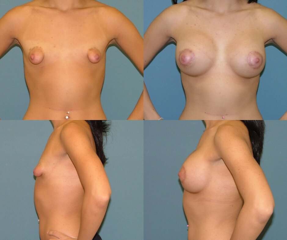 Breast Implants in West Palm Beach 