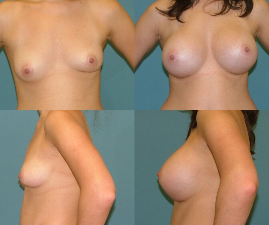Breast Augmentation with Lift in West Palm Beach 