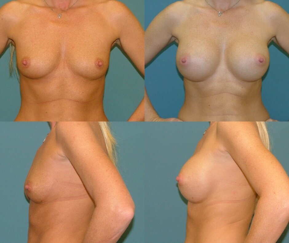 Breast Augmentation with Lift in West Palm Beach 