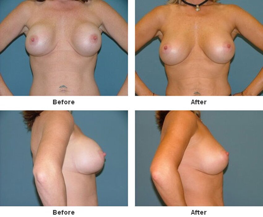 Breast Implant Revision in West Palm Beach 