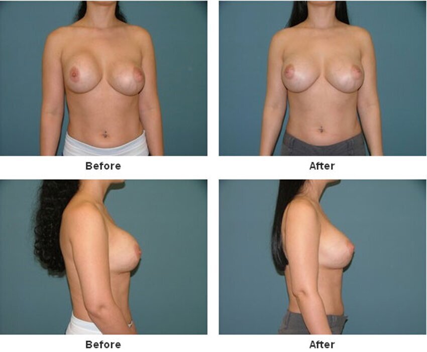 Breast Implant Revision in West Palm Beach 