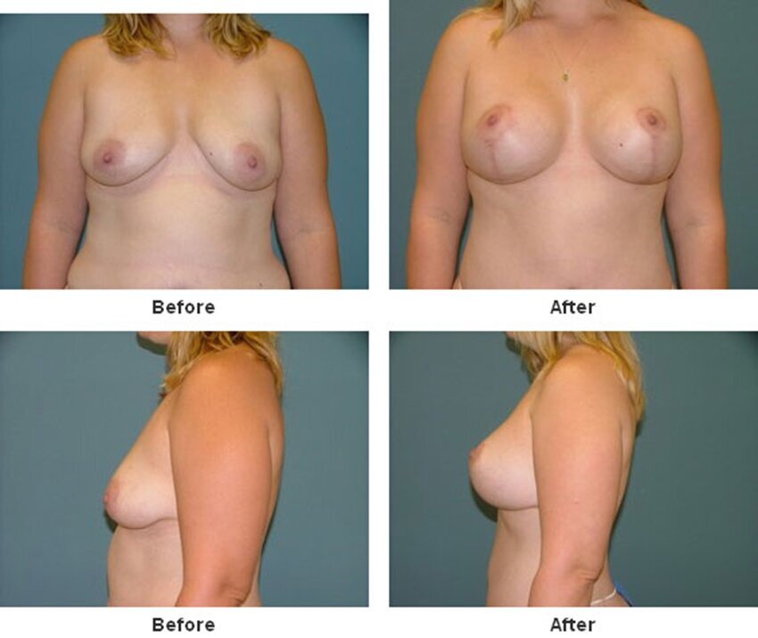 Breast Lift in West Palm Beach 