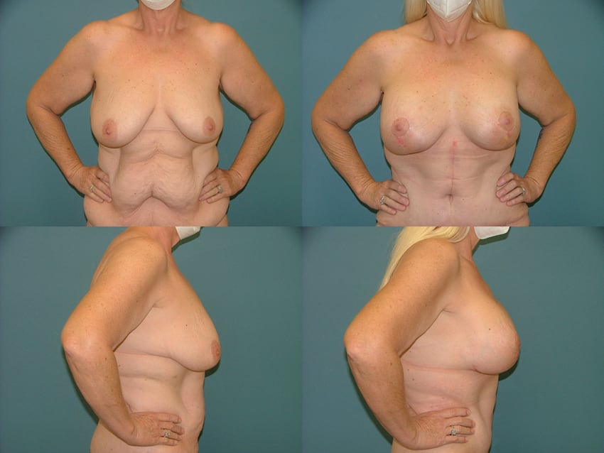 Breast Reduction in West Palm Beach 