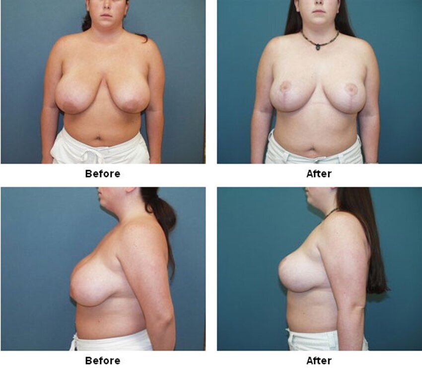 Breast Reduction in West Palm Beach 