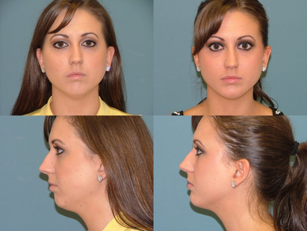 Chin Implants in West Palm Beach 