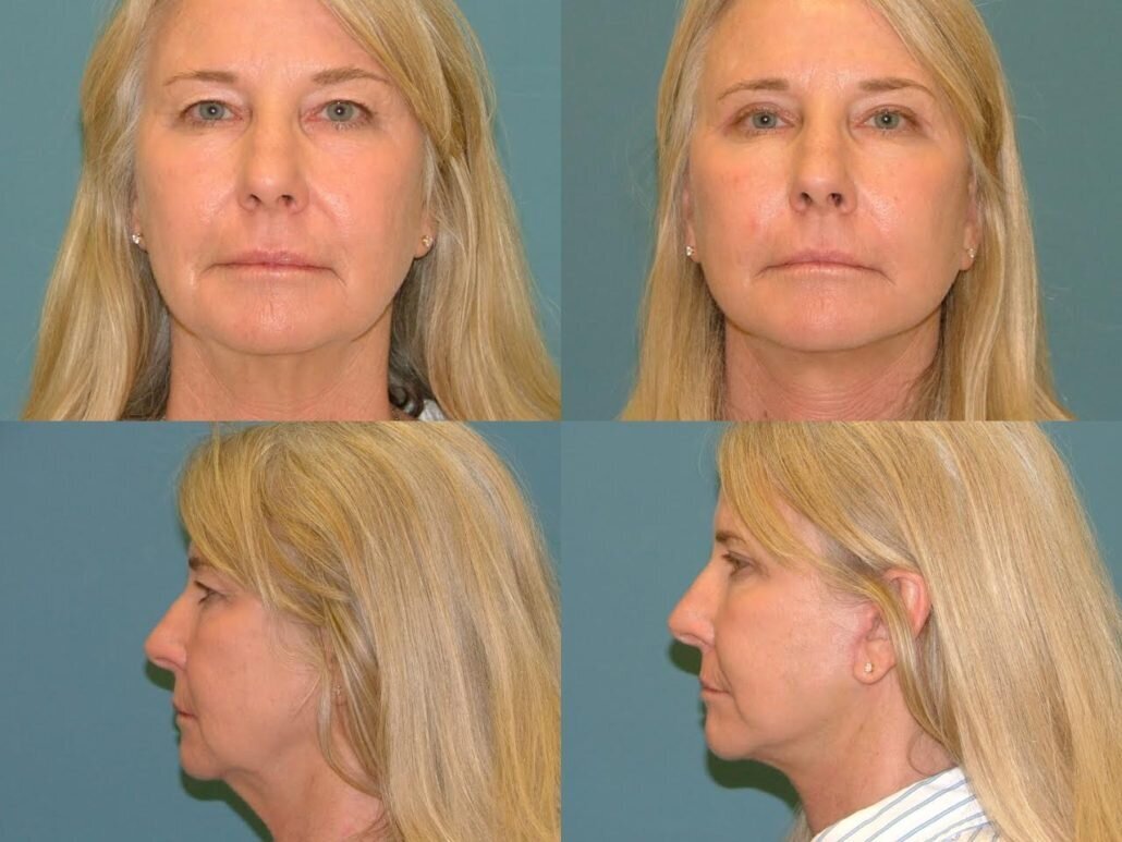 Facelift Before And After Gallery Estetica Institute