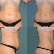 Breast Augmentation Before and After Pictures Case 123, Kalispell, MT