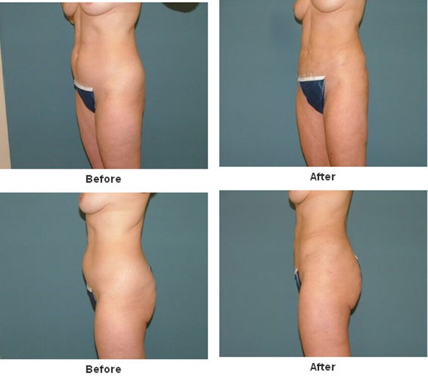 Liposuction in West Palm Beach, FL 