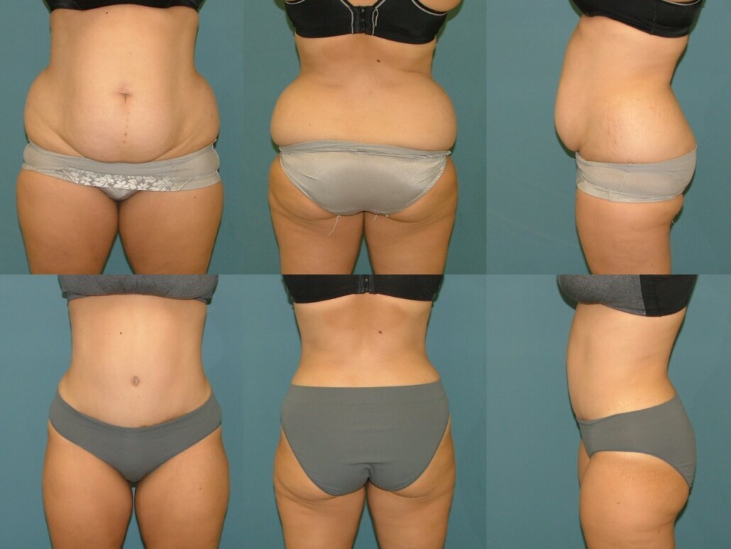 Tummy Tucks- Palm Desert, Dr. Tantawi- Abdominoplasty Palm Springs